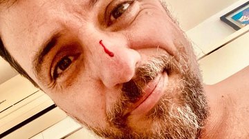 Rodrigo Lombardi surge com rosto e peitoral machucados e assusta fãs - Instagram