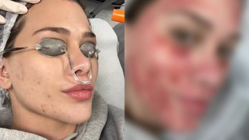 Flavia Pavanelli surge com o rosto ensanguentado após procedimento - Reprodução/Instagram