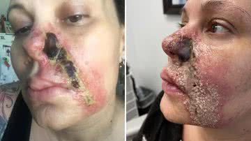 Mulher perde parte do nariz e tem pele necrosada após procedimento estético - Reprodução/NY Post