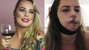 Custou caro: Mulher perde o lábio por causa de harmonização facial - Reprodução/Instagram