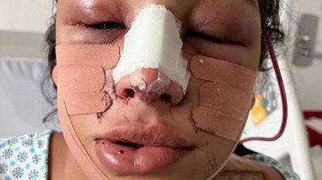 Ex-BBB Linn da Quebrada passa por cirurgias de feminilização e fãs comemoram; "Mais linda" - Reprodução/Instagram