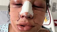 Ex-BBB Linn da Quebrada passa por cirurgias de feminilização e fãs comemoram; "Mais linda" - Reprodução/Instagram