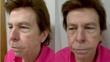 Nelson Rubens mostra antes e depois da harmonização facial e impressiona fãs: "Gostei mais" - Reprodução/TV Globo