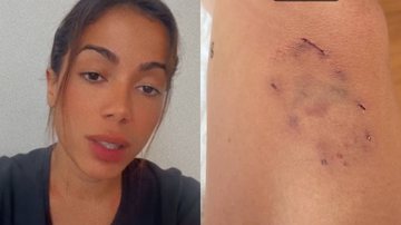 Anitta sofre acidente doméstico após briga entre seus cachorros: "Sobrou pra mim" - Reprodução/Instagram