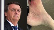 Carlos Bolsonaro publica imagem forte da perna do pai com doença grave: "Recuperação" - Reprodução/Instagram
