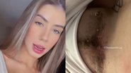 Ex de Whindersson Nunes estoura ponto de cirurgia e faz alerta: “Conscientizar” - Instagram