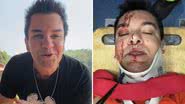 Regis Danese fica ensanguentado após sofrer grave acidente: "Muita dor" - Reprodução/Instagram