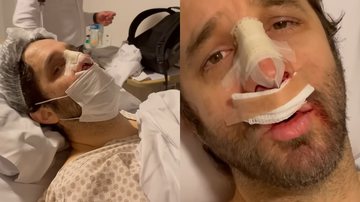 Rafinha Bastos precisou fazer uma cirurgia no nariz - Reprodução/YouTube