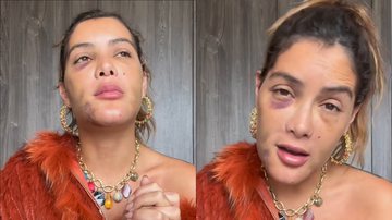 Atriz da Globo faz cirurgia de emergência após descobrir câncer no rosto: "Quase morri" - Reprodução/Instagram