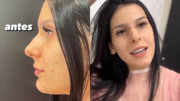 Ana Castela remodela nariz totalmente e mostra antes e depois - Reprodução/Instagram