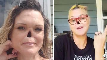Mulher que teve o nariz retirado por conta de câncer expõe dificuldades - Reprodução/Instagram
