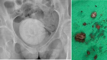 Mulher tem pedra do tamanho de uma laranja retirada da vagina - Reprodução/Urology Case Reports