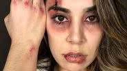 Naiara Azevedo já surgiu 'machucada' para denunciar violência doméstica - Reprodução/Instagram