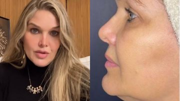 Viúva de Leandro revela resultado de procedimento no rosto - Reprodução/Instagram