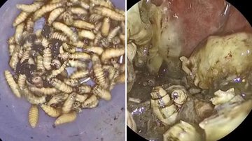 Após meses com desconforto, homem tem 150 larvas encontradas dentro do nariz - Reprodução/Extra