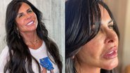Gretchen faz novo procedimento facial e mostra resultados: "Olha isso!" - Reprodução/Instagram