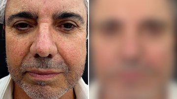 Aos 65 anos, João Kleber mostra antes e depois da harmonização facial: "Milagre" - Reprodução/Instagram