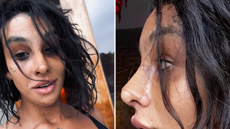 Linn da Quebrada mostra resultado de cirurgia de feminilização: "Biologicamente travesti" - Reprodução/Instagram