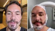 Transplante de barba feito por Eliezer custa caríssimo - Reprodução/Instagram