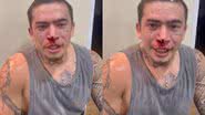 Whindersson Nunes surge com o rosto coberto de sangue após luta - Instagram