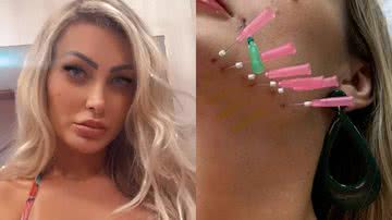 Chocante! Andressa Urach faz procedimento estético e surge com 18 agulhas no rosto: "Não dói nada" - Reprodução/Instagram