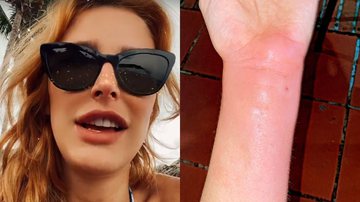 Eita! Após picada de inseto, Rafa Brites mostra pulso lesionado e relata: "Parecia que estavam enfiando uma agulha" - Reprodução/Instagram