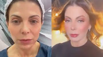 Sheila Mello mostra antes e depois de retoque do botox - Reprodução/Instagram