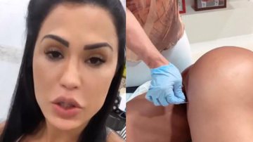 Gracyanne Barbosa revela lesão no bumbum e mostra tratamento inusitado - Reprodução / Instagram