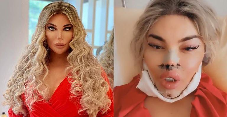 Jéssica Alves tem infecção feia após procedimento estético e faz nova cirurgia: "Produto saía pelo queixo" - Reprodução/Instagram