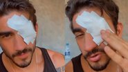 Gui Napolitano machuca olho durante partida de futebol de sabão - Instagram