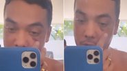 Wesley Safadão surge com o olho roxo e revela procedimento no rosto - Instagram