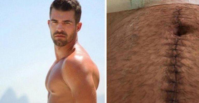 Borat do Amor & Sexo mostra cicatriz após ser baleado - Reprodução/Instagram
