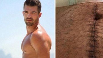 Borat do Amor & Sexo mostra cicatriz após ser baleado - Reprodução/Instagram