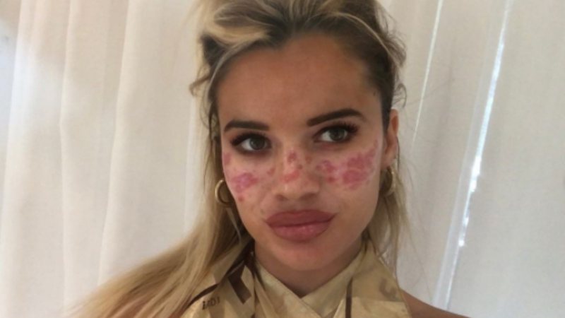 Eita! Ex-BB australiana revela como ganhou cicatrizes na pele após reproduzir truque de beleza duvidoso da internet - Reprodução/Instagram
