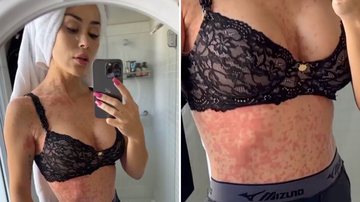 Ex-BBB Letícia Santiago surge toda inflamada e assusta fãs: "Esperando diagnóstico" - Reprodução/Instagram