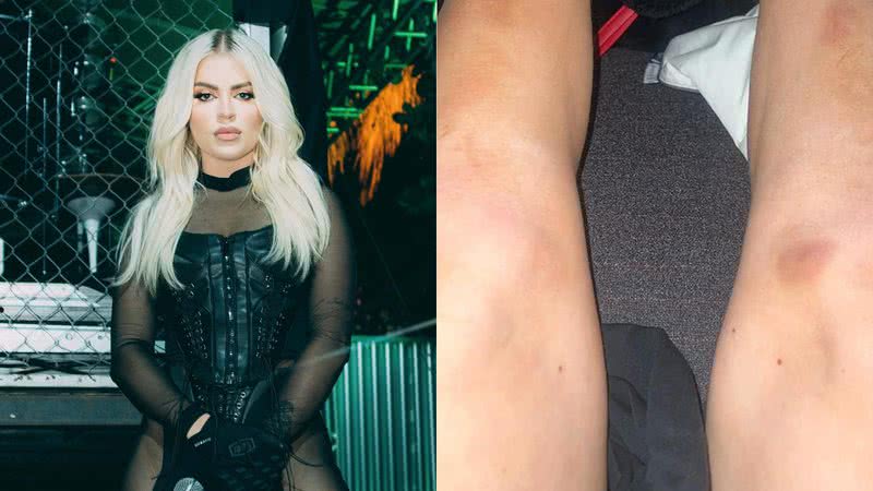 Luísa Sonza surge com pernas cheias de hematomas e assusta fãs - Instagram