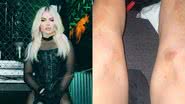 Luísa Sonza surge com pernas cheias de hematomas e assusta fãs - Instagram