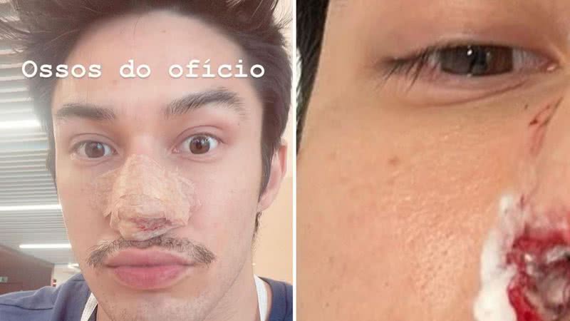 Ginasta Arthur Nory se acidenta e sofre fratura no nariz: “Não é fácil” - Reprodução/Instagram