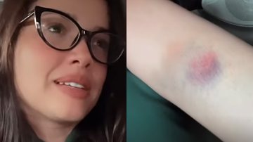 Ex-BBB Juliette mostra hematomas no corpo e explica motivo - Reprodução/Instagram
