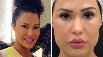 A musa fitness Gracyanne Barbosa faz procedimento estético no rosto e mudança impressiona fãs com antes e depois; confira - Reprodução/Instagram