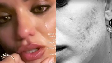 Ex-BBB Rafa Kalimann mostra acne severa no rosto e desabafa - Reprodução/Instagram