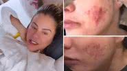 Esposa de Leonardo surge com a pele irreconhecível e lamenta: "Extremamente ansiosa" - Reprodução/Instagram