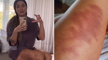 Juju Salimeni assusta ao mostrar perna tomada por hematomas: “Dói na alma, fica marcado” - Reprodução/Instagram