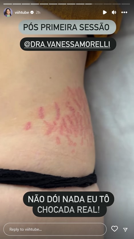 Viih Tube mostra eliminação de estrias na barriga dois meses pós-parto: "Tô chocada"