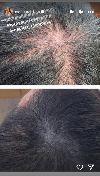 Gretchen - tratamento alopecia