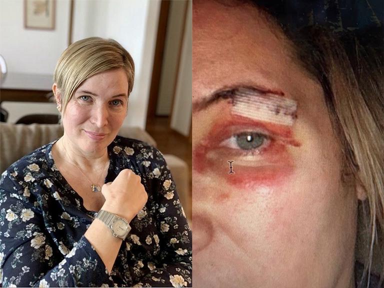 Ex-Paquita Luise Wischermann revela luta contra a esclerose múltipla e mostra machucado