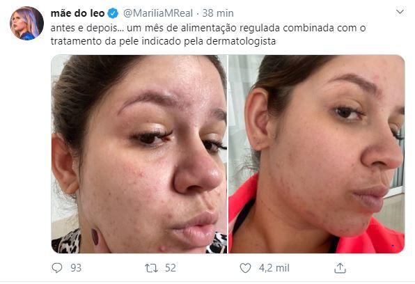 Marília Mendonça revela mudança na pele após reeducação alimentar