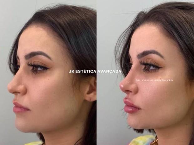 Bianca Andrade passa por procedimento estético e mostra resultado
