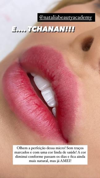 Flavia Pavanelli mostra 'antes e depois' de procedimento nos lábios