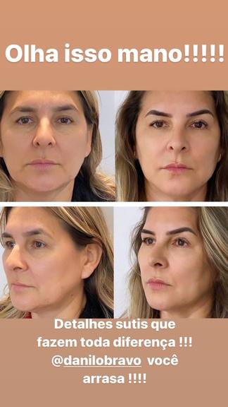 Naiara Azevedo mostra 'antes e depois' de procedimento da mãe